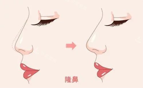 ​韩国GNG整形做鼻子好吗，假体隆鼻肋骨隆鼻鼻修复技术满分！