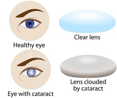 白内障为眼球带来的变化图解
