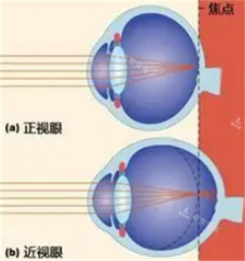 正常眼睛和近視眼鏡的不同