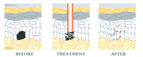 光子嫩肤改善皮肤斑点