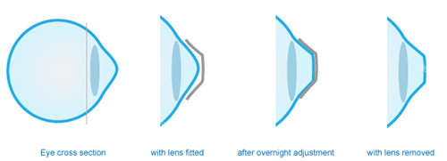 角膜塑形镜可以改善眼表曲度