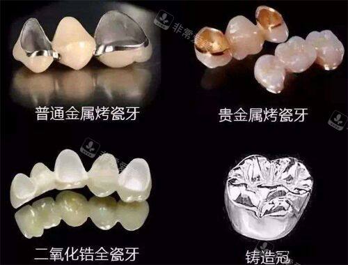 不同材质的牙冠