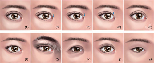 不同眼型做完双眼皮手术的样子图解