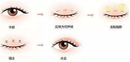 韩式双眼皮