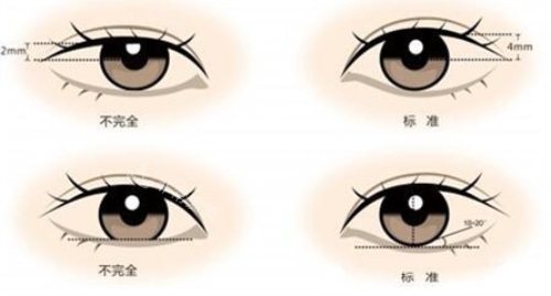 ​韩国汝好Luho整形做眼睛好吗，双眼皮开眼角眼修复技术一绝！ 