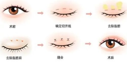 ​韩国汝好Luho整形做眼睛好吗，双眼皮开眼角眼修复技术一绝！ 