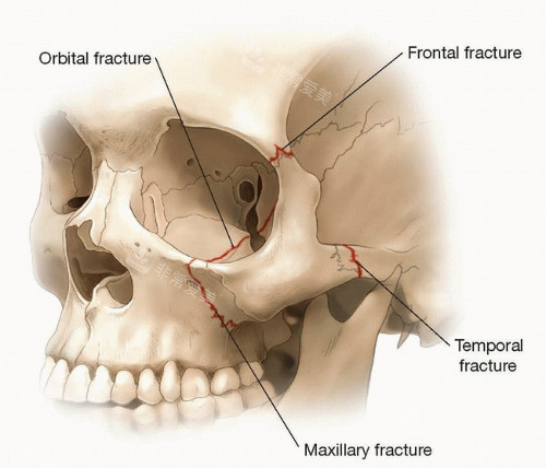 颧骨颧弓位置结构图