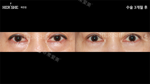 韓國赫爾希整形外眼部整形前后圖 韓國赫爾希整形外眼部整形前后圖