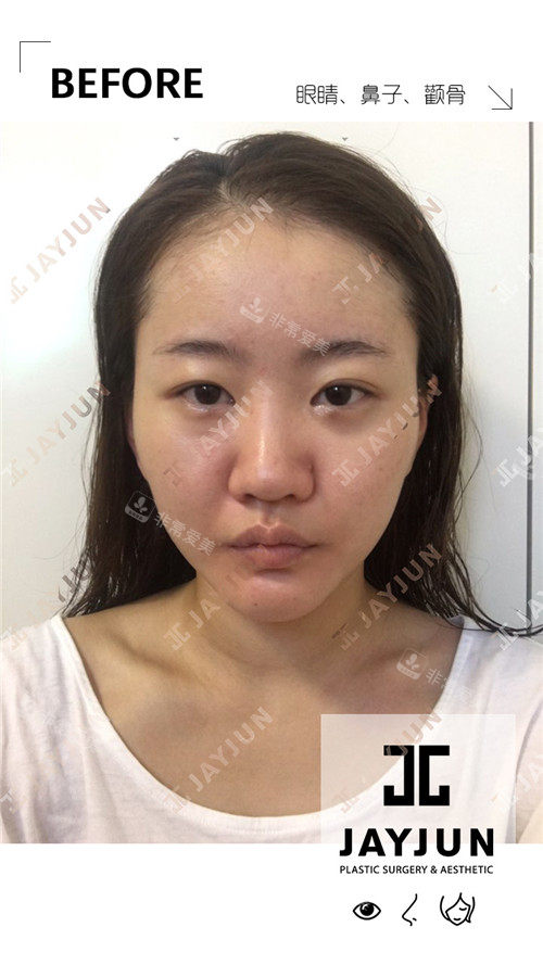 韓國jayjun整形做整形術前照片 韓國jayjun整形做整形術前照片