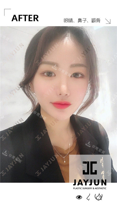 韩国jayjun整形做眼鼻整形和颧骨整形术后照片