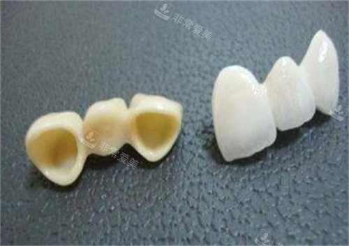 不同材质牙冠的区别图片