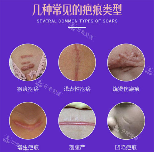 几种常见的疤痕类型