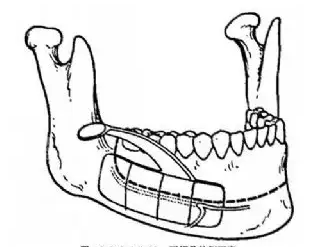 下顎動(dòng)畫(huà)示意圖 下顎動(dòng)畫(huà)示意圖