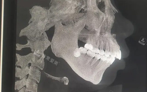 需要做正頜手術(shù)的骨骼圖 需要做正頜手術(shù)的骨骼圖