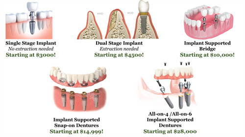 种植牙手术过程图