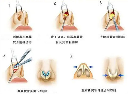 鼻翼手术步骤图