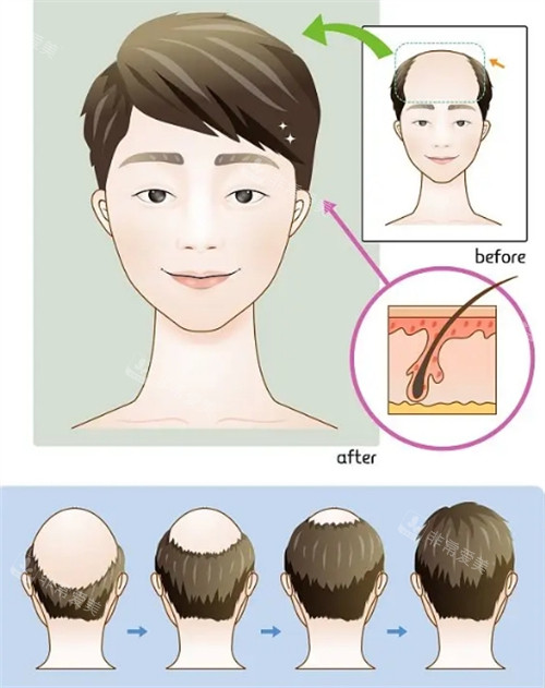 毛发种植流程