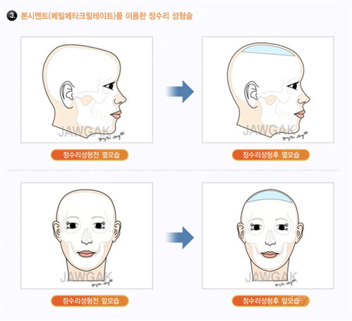 韩国雕刻医院颅顶填充动画对比图