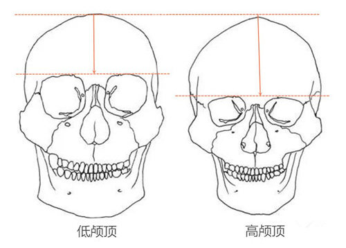 高颅顶和低颅顶对比照