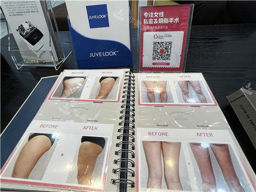韩国qline医院吸脂价格很低！是韩国少有的技术但是收费低的一家吸脂医院！