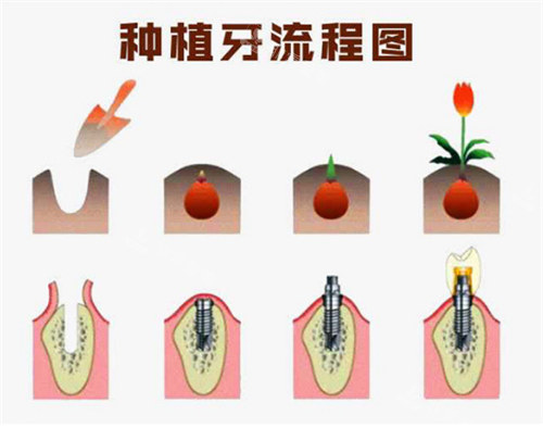 种植牙流程