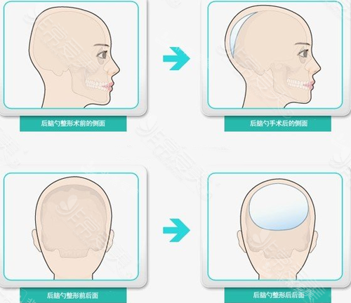 头部整形原理图示