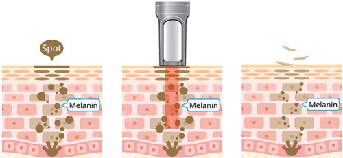 激光祛斑在皮肤底部改善黑色素
