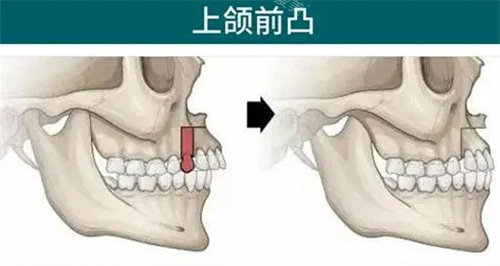 上颌前突正颌手术