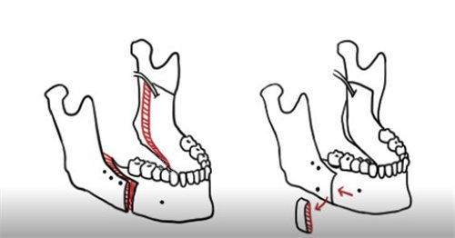 正颌手术过程