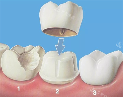 牙冠佩戴过程图解