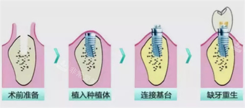 种植牙过程图解