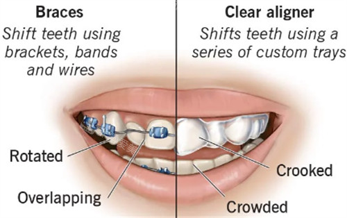 自锁金属牙齿矫正和隐形牙齿矫正的区别图解