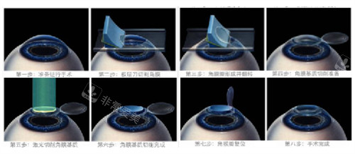 角膜交叉结合术手术过程图解