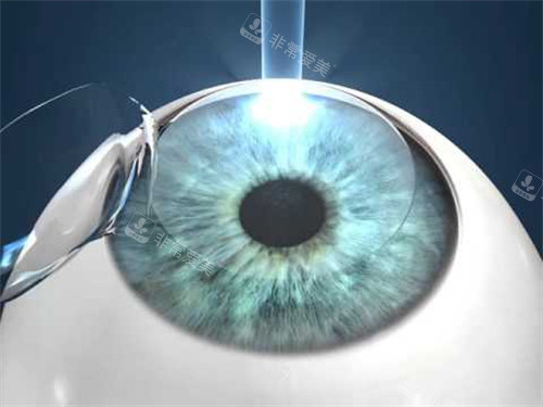 人工晶体植入眼睛图示