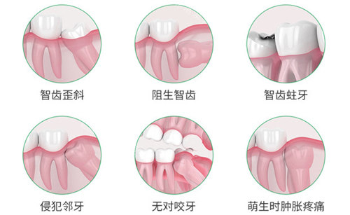 需要拔除智齿的几种情况