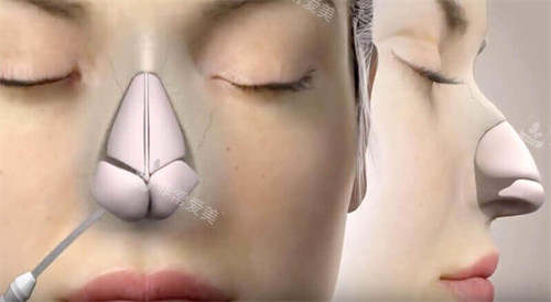 隆鼻手术动画图