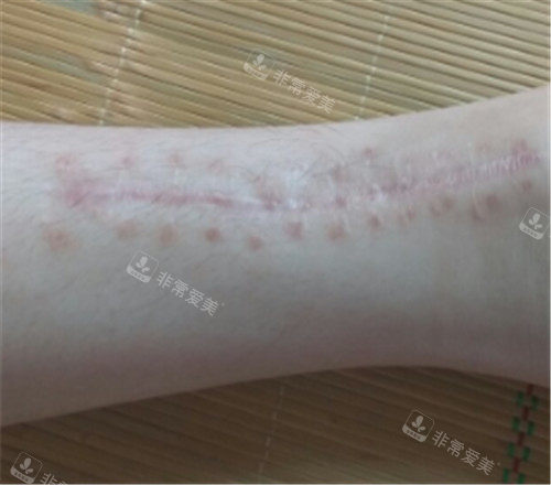 韩国去疤痕技术怎么样？想知道韩国疤痕修复技术到底有多好？
