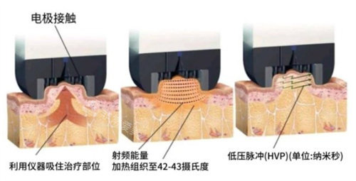 韩国elev皮肤科提升技术如何？非流水线皮肤科更细致有效~