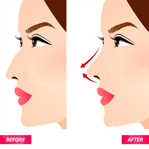 隆鼻手术改善鼻子角度