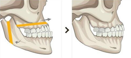 双鄂手术前后对比图