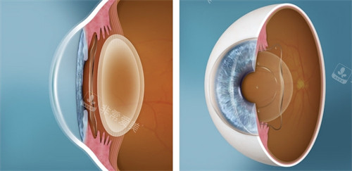 人工晶体植入眼睛对比