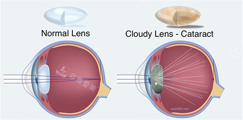 白内障图示
