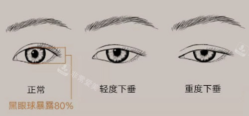 眼瞼下垂程度圖 眼瞼下垂程度圖