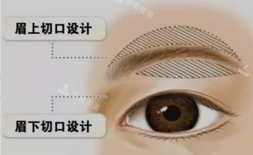 提眉手術圖示 提眉手術圖示
