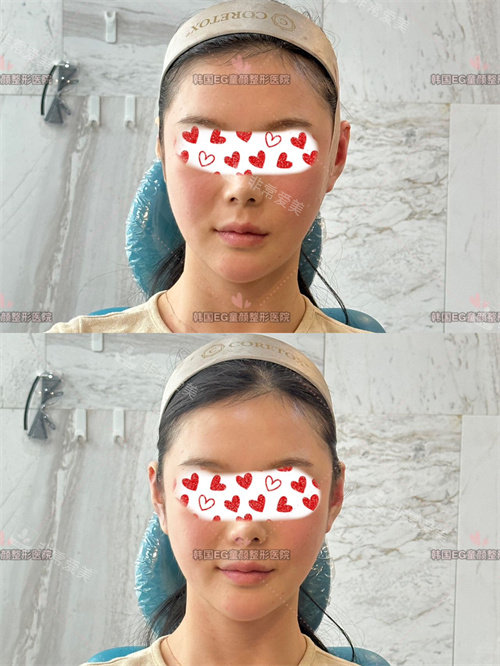 精靈耳填充 精靈耳填充