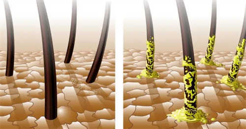 健康毛囊与脂溢性毛囊的区别对比图