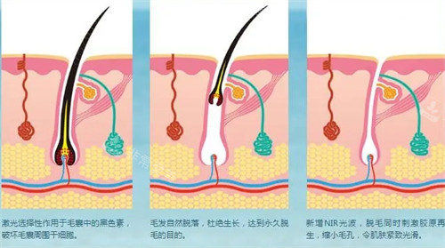 激光脱毛原理