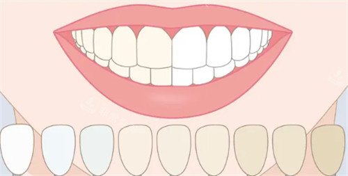不同颜色牙齿对比图