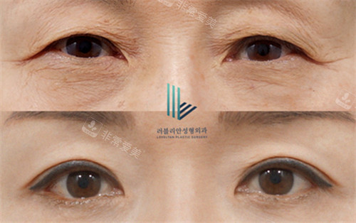 韩国乐于丽颜整形外科眼部整形前后对比图