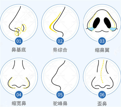 韩国做假体隆鼻怎么样?我做的Fit me3D打印鼻真心nice！